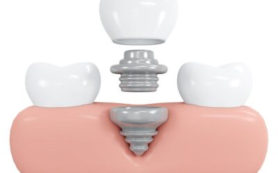 Κίνδυνος αποτυχίας βραχέων οδοντικών εμφυτευμάτων υπό άμεση φόρτιση