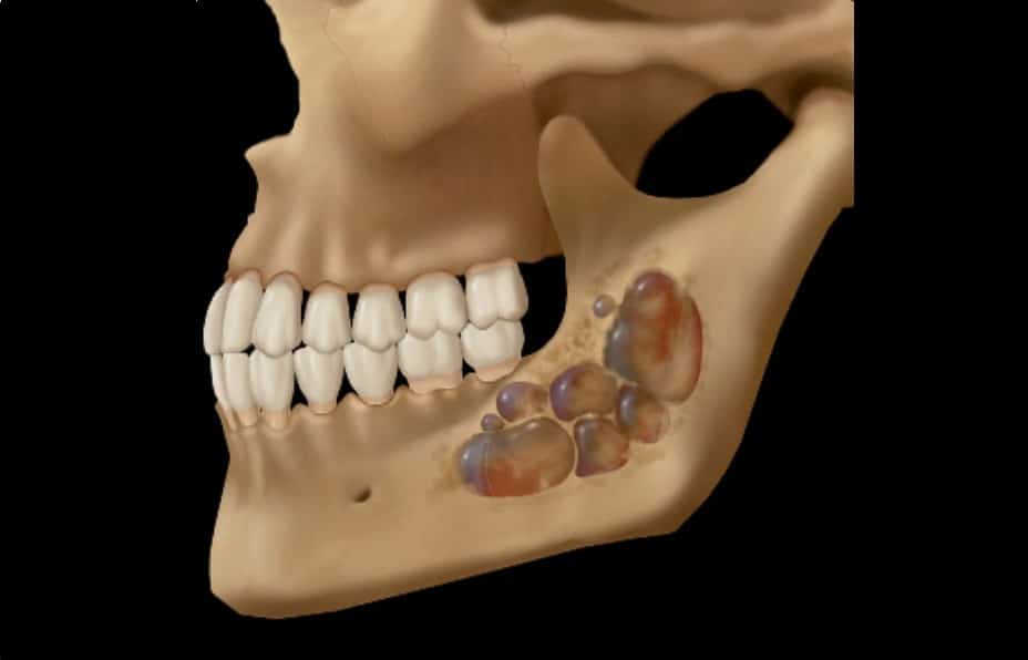 Αδαμαντινοβλάστωμα: Ένας σπάνιος όγκος της γνάθου