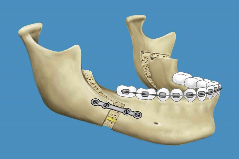 Οβελιαία Οστεοτομία Κάτω Γνάθου