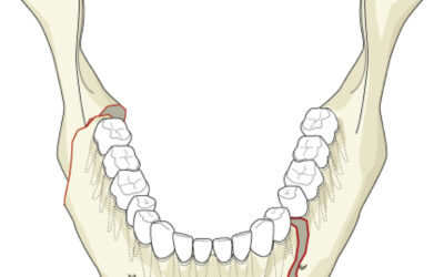 Κάταγμα κάτω γνάθου – Διάγνωση και θεραπεία